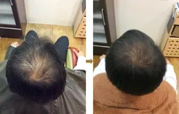 リバースエイジング